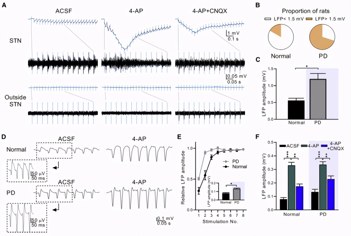 帕金森患者典型的震颤,帕金森病震颤的神经环路机制