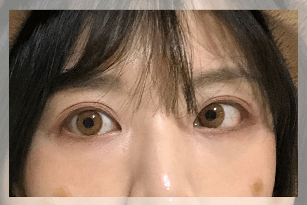 一次就能让黑眼圈消失的办法,一针下去瞬间没了黑眼圈