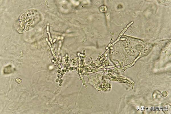 女性*处私**瘙痒不断，是咋回事？怎么能快速止痒？听听医生怎么说