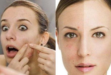 月球表面的脸如何才能治好,月球脸祛痘的正确方法