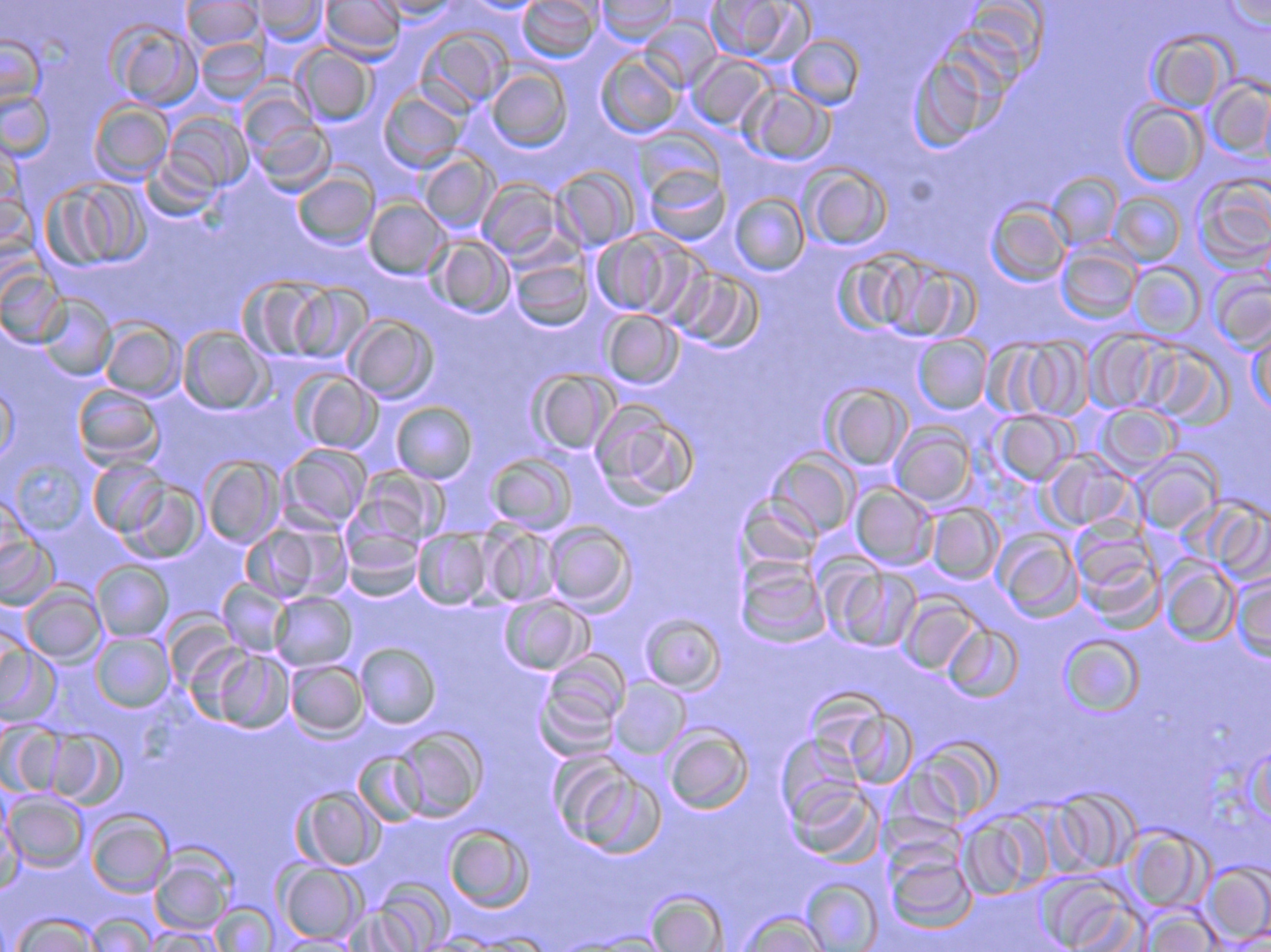血液粘稠的病因及治疗,健康血液粘稠别小看但也别乱治