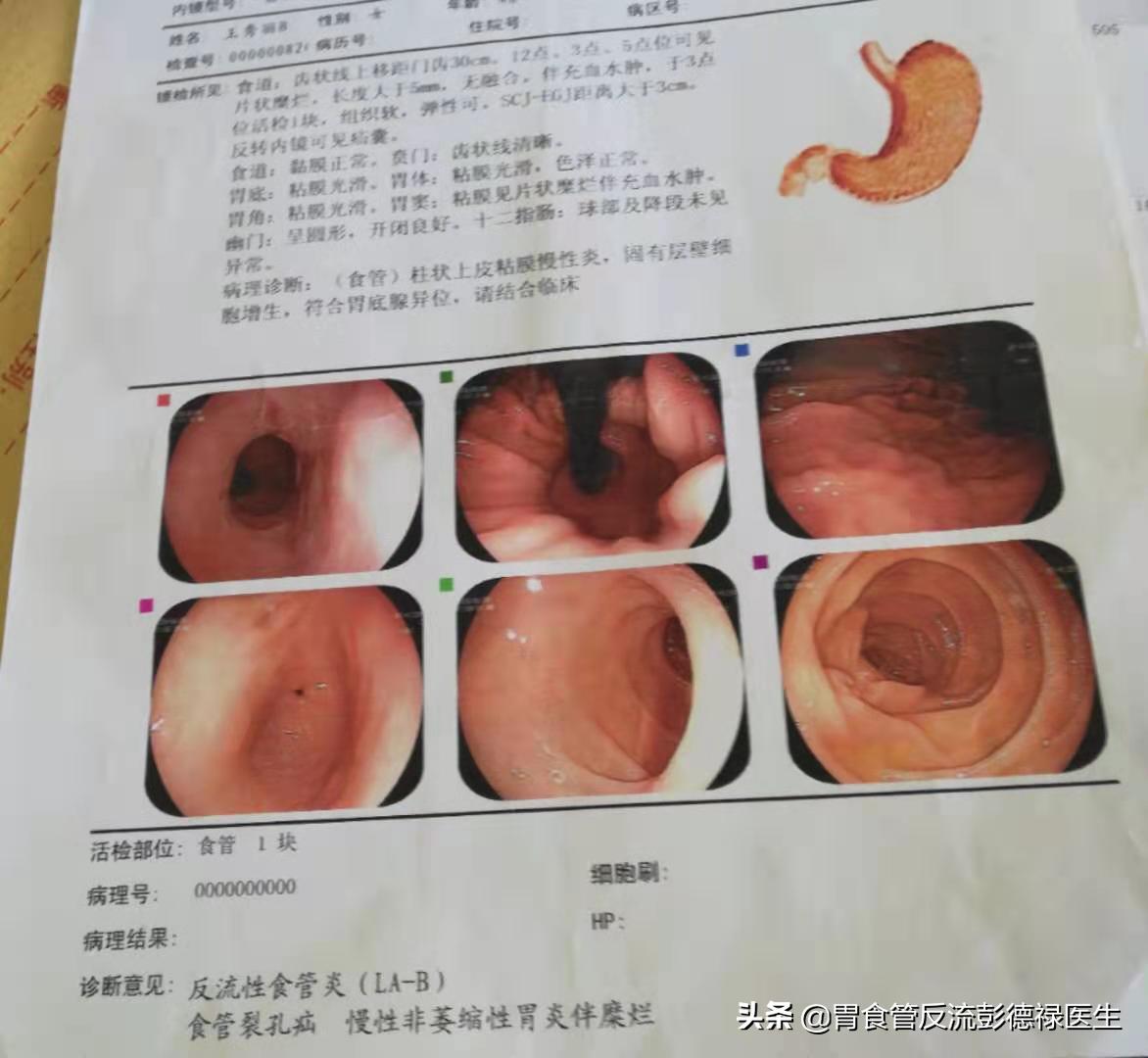 胃胀二十年,胸闷气短是胃胀还是食管反流