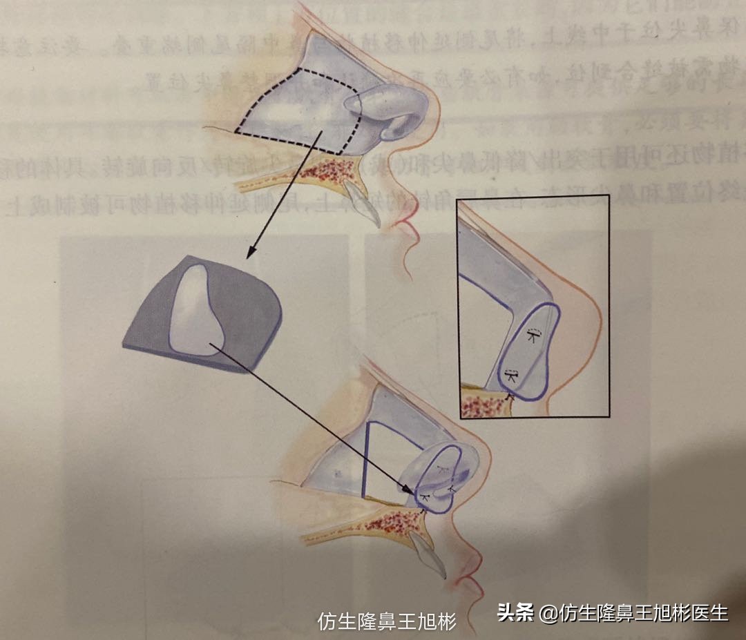 鼻中隔重塑鼻头,鼻中隔重建整形