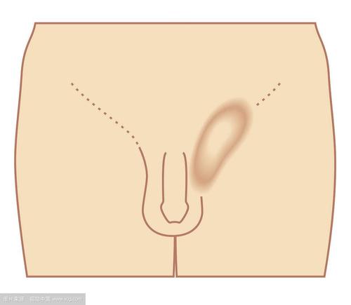 婴儿腹部突出有疝气,宝宝肚脐疝气鼓包图片