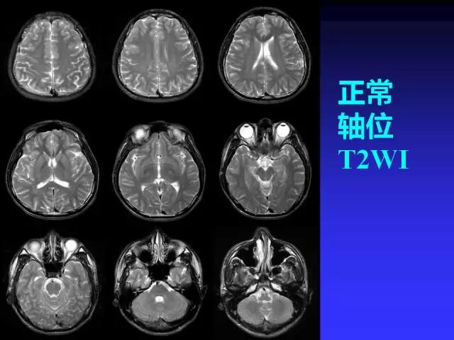 头颅mri读片视频教程,颅脑mri读片入门教程视频讲解全集