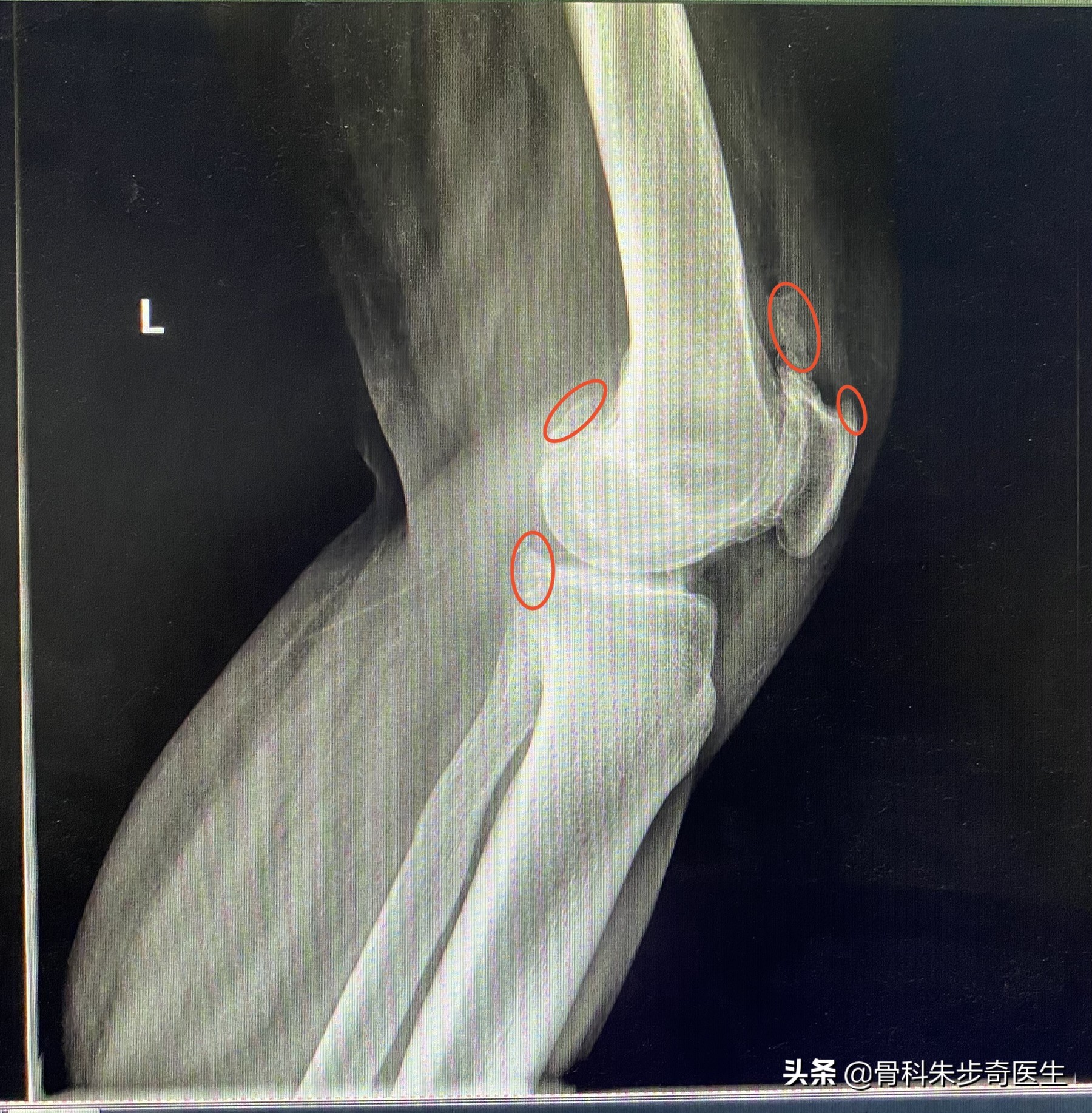 膝关节上面的骨刺该怎么解决,年轻人膝关节骨刺是怎样引起的