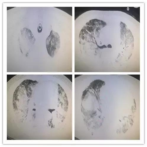 罕见病误诊的真实案例,误诊漏诊导致病人肿瘤癌变