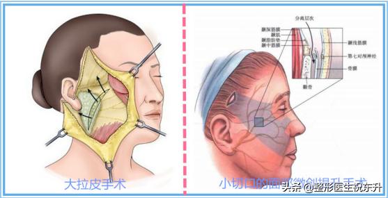55岁如何做面部提升术好,40岁适合哪种面部提升手术