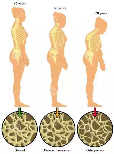老年人驼背变矮怎么办,老年人驼背是骨质软化症吗