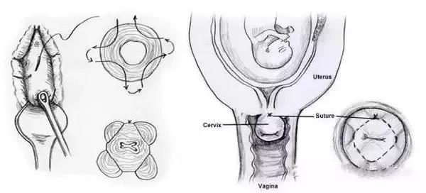 试管双胞胎一胎胎停会流血吗,试管双胞胎有一个胎停了