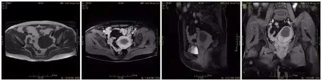 专家讲治疗子宫肌瘤的方法,微创介入子宫肌瘤栓塞术