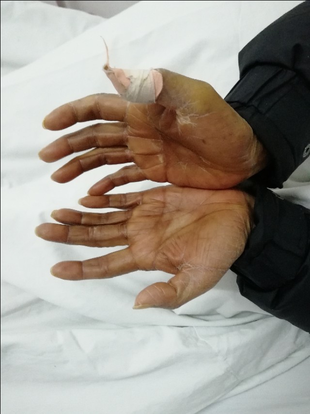 这个阿姨手脚破溃是怎么了？