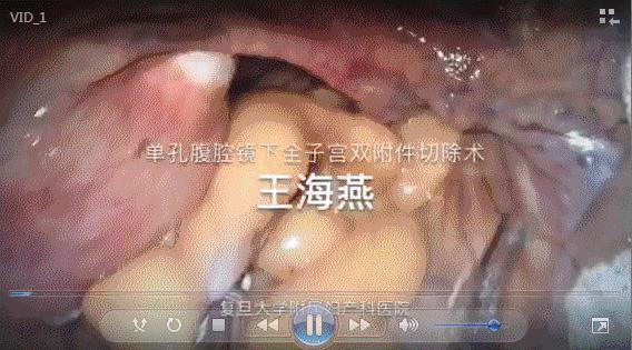 NO.2王海燕副主任医师：单孔腹腔镜下全子宫双附件切除术