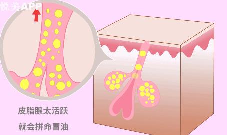 皮肤粗糙毛孔粗大出油改善方法,皮肤出油毛孔粗大吃什么药改善