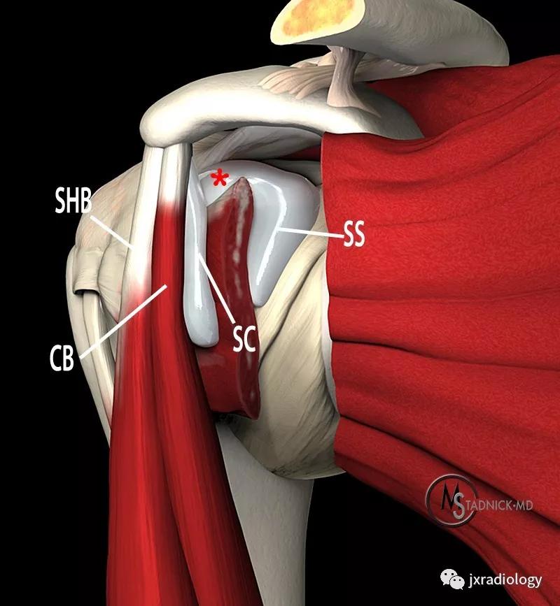 肩关节周围滑囊有哪些,肩关节滑囊疝严重吗