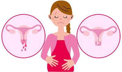 试管降调打达菲林一直出血怎么办,试管前打完达菲林20天出血了