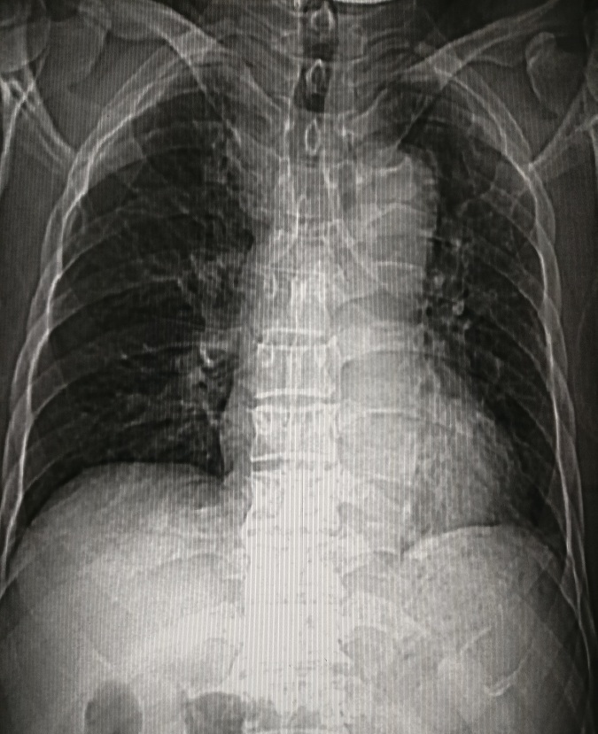 循环系统胸片,体循环和肺循环临床表现