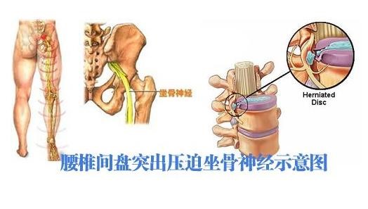 坐骨神经放射性疼痛几天自愈,坐骨神经痛14天自愈方法有哪些