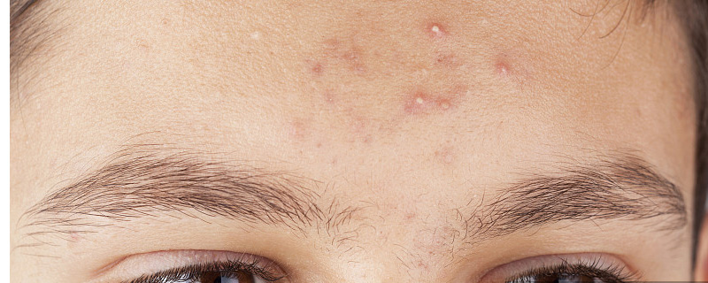 额头长痘怎么办才能快速消除,额头长痘了怎么快速消除