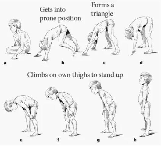 皮肌炎或多发性肌炎的诊断标准,成人皮肌炎与儿童皮肌炎区别