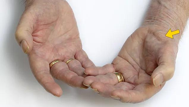 肌肉萎缩治的好么,肌肉萎缩病能治好吗