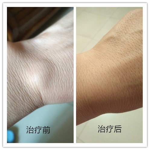 手腕疼并冒出一个包,一干活手腕就疼