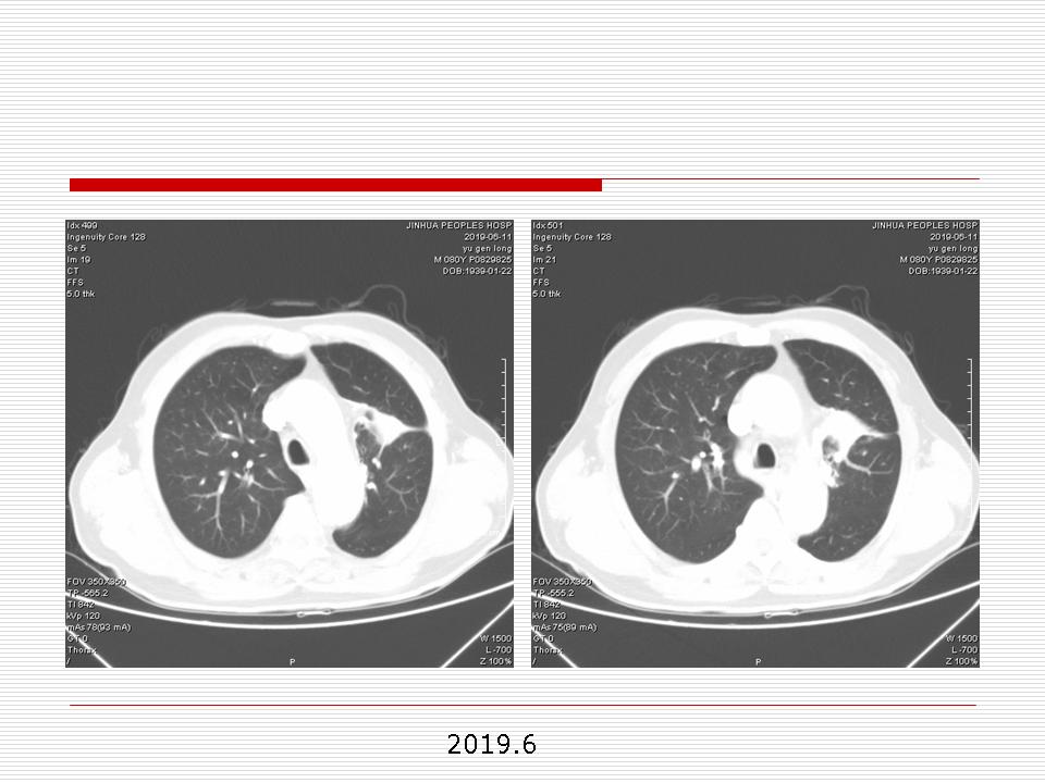 像炎症的肺癌能治好吗,医生说可能是肺癌也可能是炎症