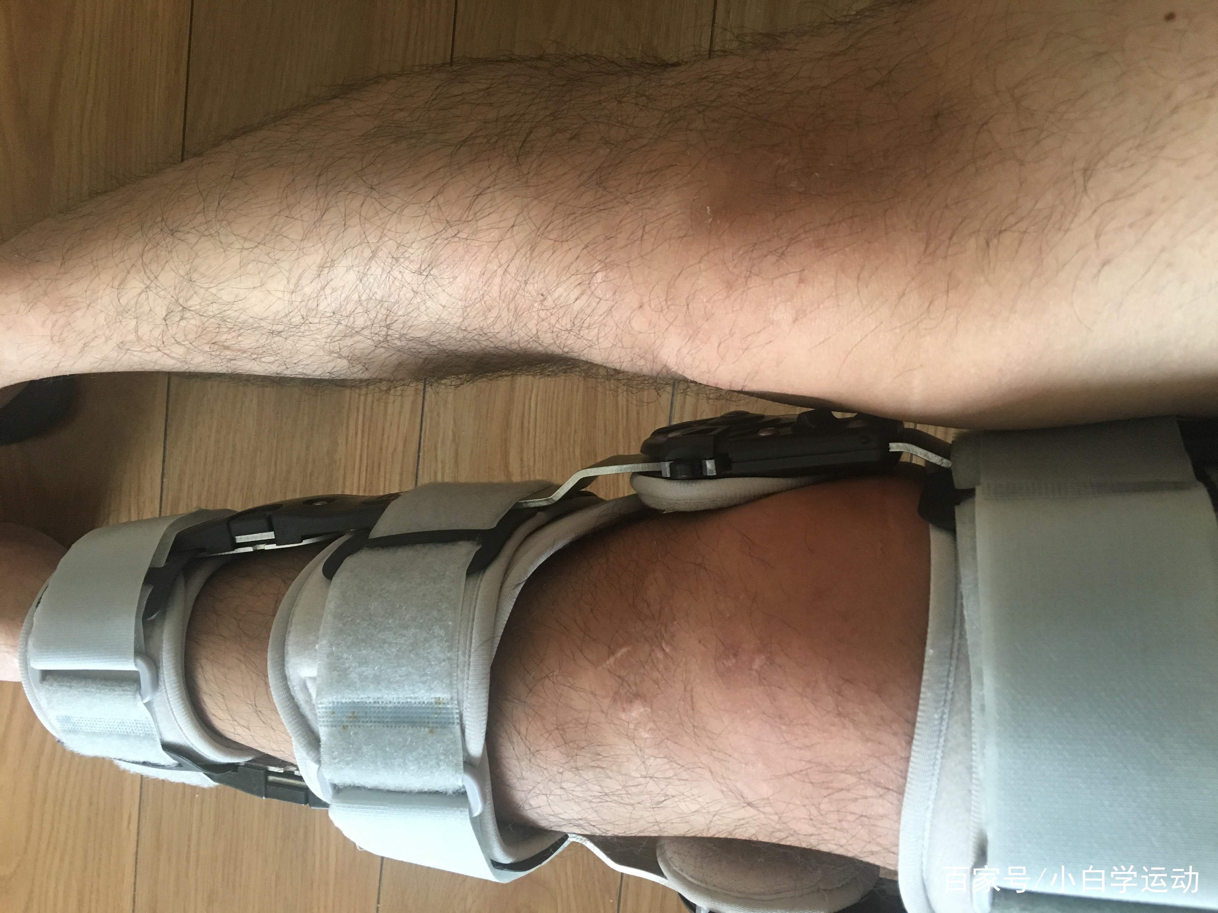 疤痕贴瑞典墨尼克术后多久用,瑞典墨尼克美皮护