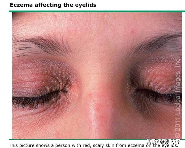 宝宝湿疹妈妈应注意哪些,宝宝湿疹反复妈妈要一直忌口吗