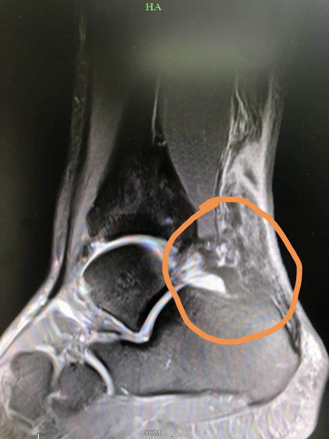 “我要减肥”！杭州33岁小伙儿连打四天羽毛球后，“脚筋”断了……