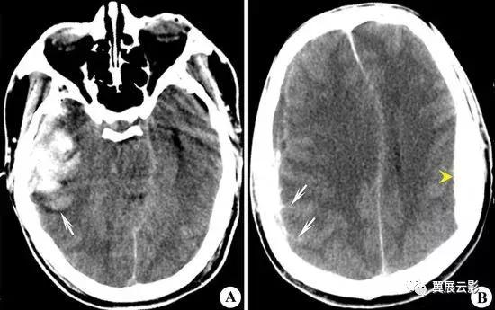 脑脓肿增强扫描是环形强化吗,脑部脓肿