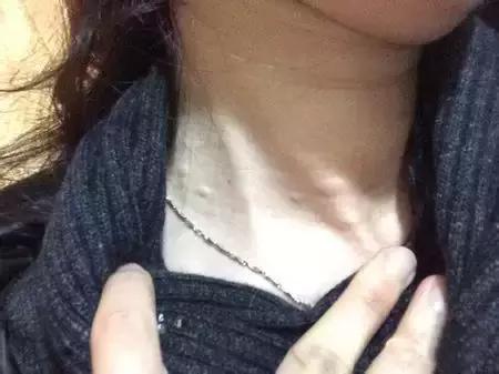 脖子上长痣小肉粒,脖子上长小肉粒要注意啦