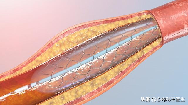 心脏支架4年了停阿司匹林行吗,冠心病放支架后仍然隐痛