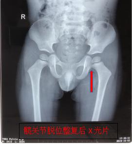 小孩髋关节脱臼复位手法视频,宝宝髋关节脱位可以正骨复位吗