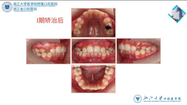 儿童9岁下颌后缩矫治,高角下颌后缩怎么矫治