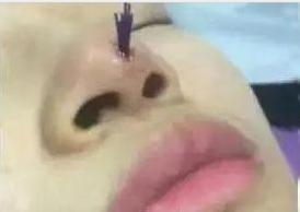 线雕隆鼻是真的吗,线雕隆鼻能维持几年还是那么挺