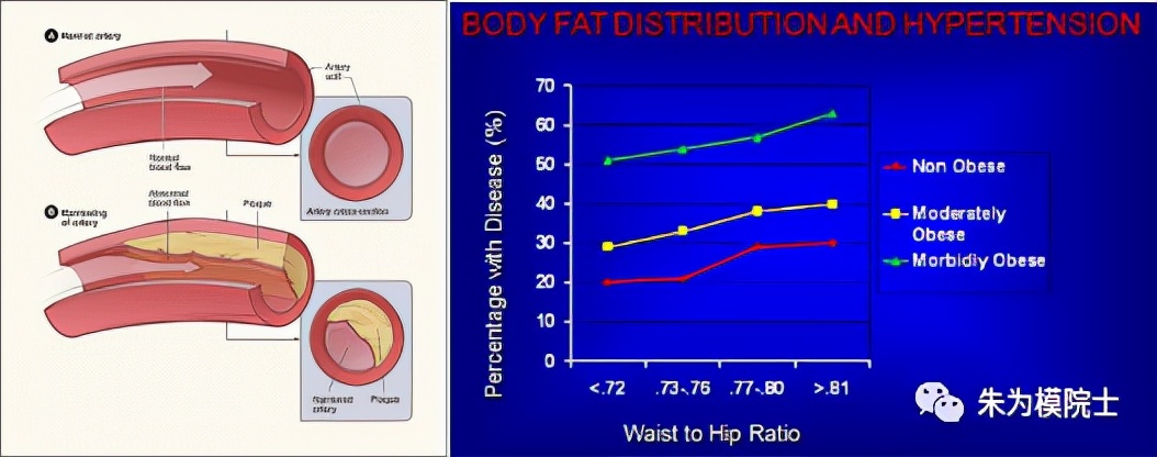 中风健康小知识,中风西医怎么预防