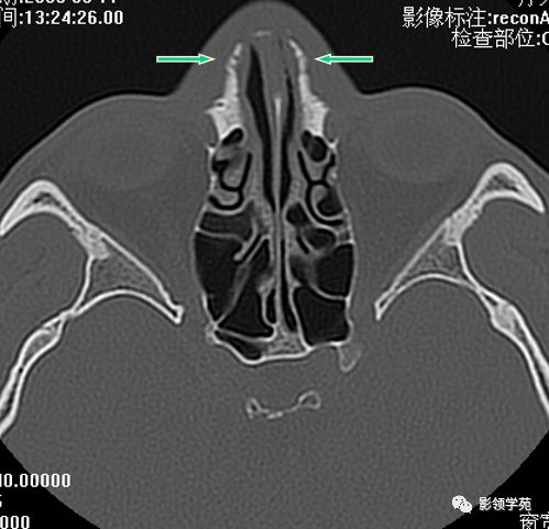 鼻骨影像学解剖,鼻骨解剖及骨折影像学诊断