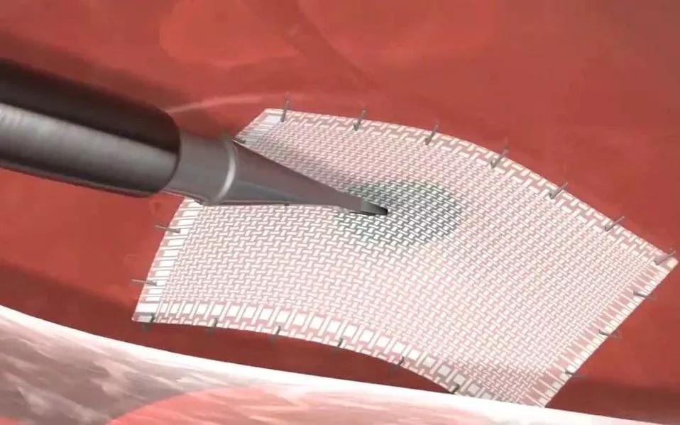 “大爷，你的肠子怎么老往外掉？”