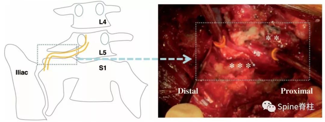 下肢疼痛是腰椎间盘突出引起的吗,下肢放射痛查不出原因