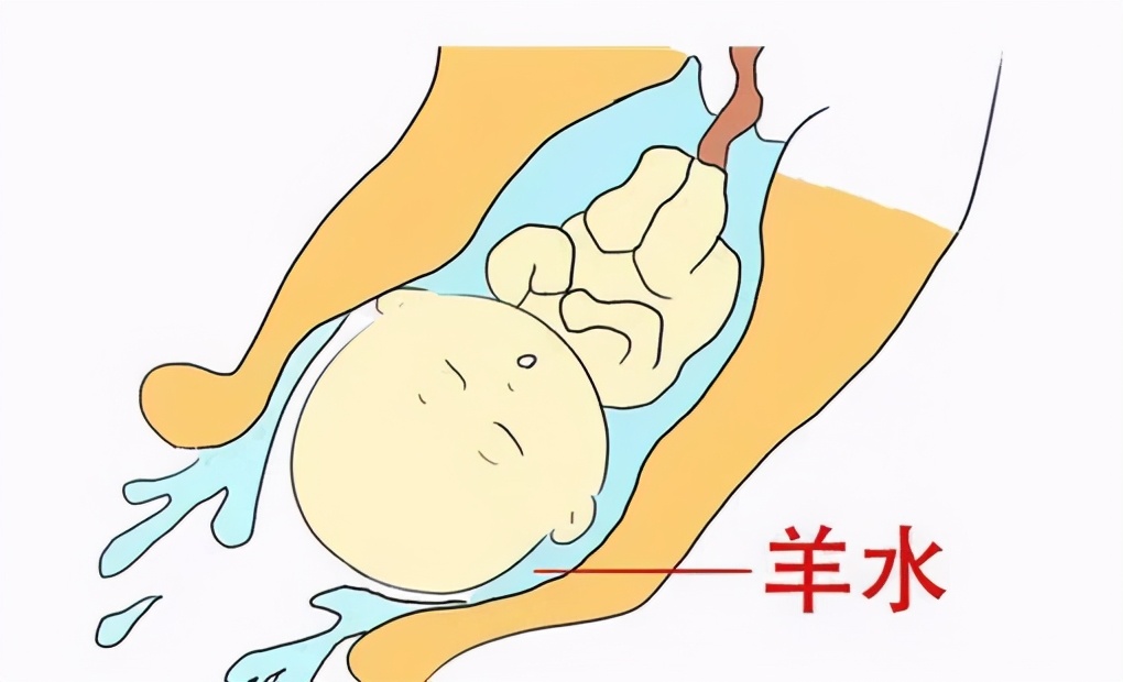 孕36周咳嗽漏尿还是羊水破了,孕晚期分不清楚是破羊水还是漏尿