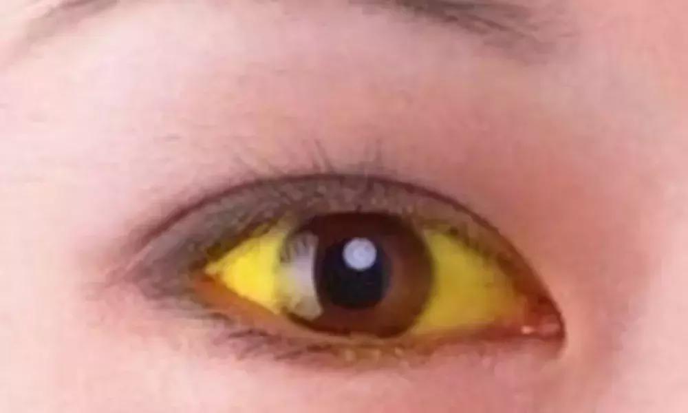 胆管结石和胆囊切除需要多长时间,胆管结石胆囊也切除手术后的饮食