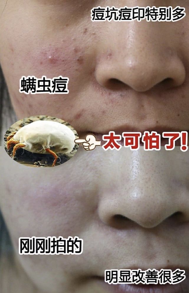 脸油痘痘多黑头用什么简单洗干净,清理黑头痘痘的最简单方法