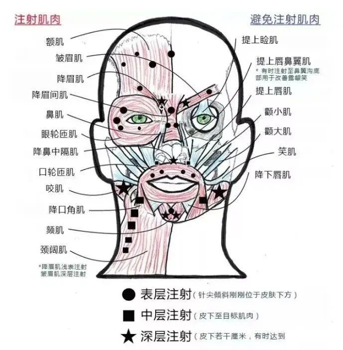 肉毒素瘦脸会不会面部僵硬,打瘦脸后脸僵硬怎么恢复快