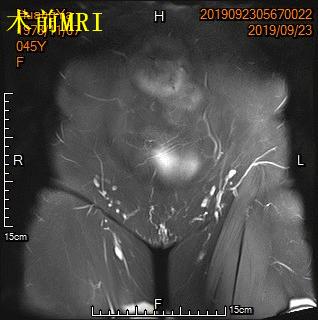 子宫肌瘤的位置、大小对介入栓塞疗效有何影响？