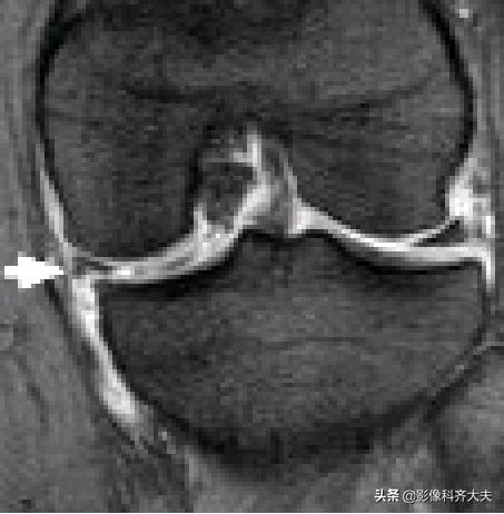 膝关节半月板损伤的磁共振,膝关节半月板病变的mri诊断与鉴别