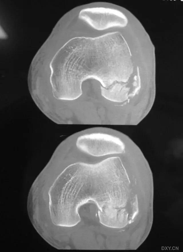 特殊骨折类型,特殊骨折体征