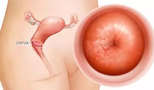 妇科疾病信号,妇科检查血流信号