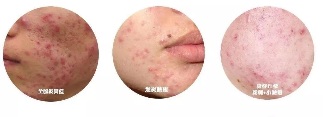 面部细菌感染,面部细菌怎么消除