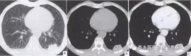 肺部有球形病灶怎么治疗,肺内多发结节诊断早期肺癌怎么办